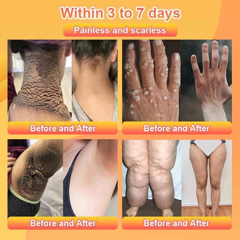 Purifying Exfoliating Gel for Acanthosis Nigricans, Exfoliation, Dark Spots, Skin Tags, and Eczema 🍊