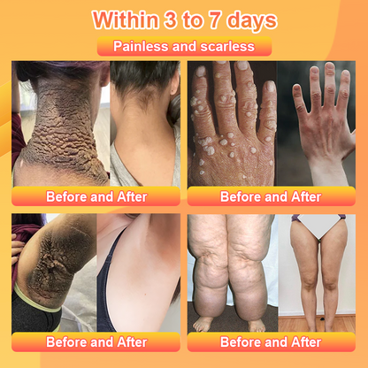 Purifying Exfoliating Gel for Acanthosis Nigricans, Exfoliation, Dark Spots, Skin Tags, and Eczema 🍊