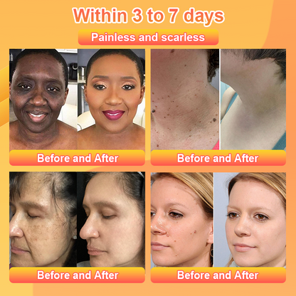 Purifying Exfoliating Gel for Acanthosis Nigricans, Exfoliation, Dark Spots, Skin Tags, and Eczema 🍊
