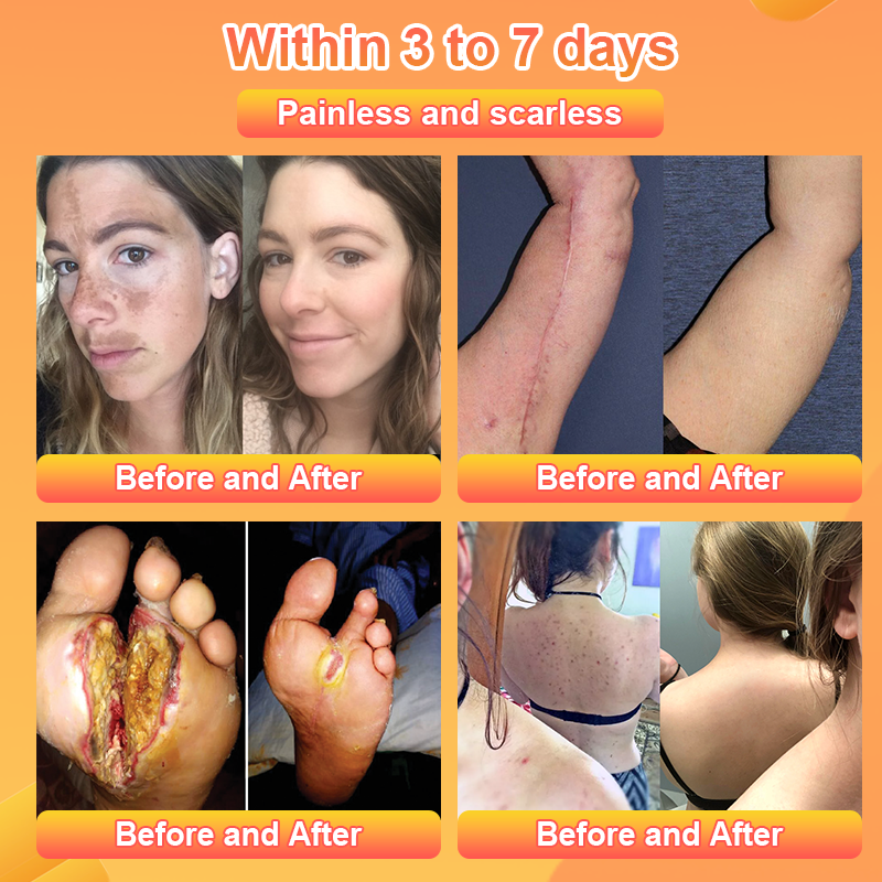 Purifying Exfoliating Gel for Acanthosis Nigricans, Exfoliation, Dark Spots, Skin Tags, and Eczema 🍊