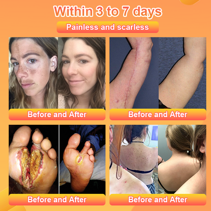 Purifying Exfoliating Gel for Acanthosis Nigricans, Exfoliation, Dark Spots, Skin Tags, and Eczema 🍊