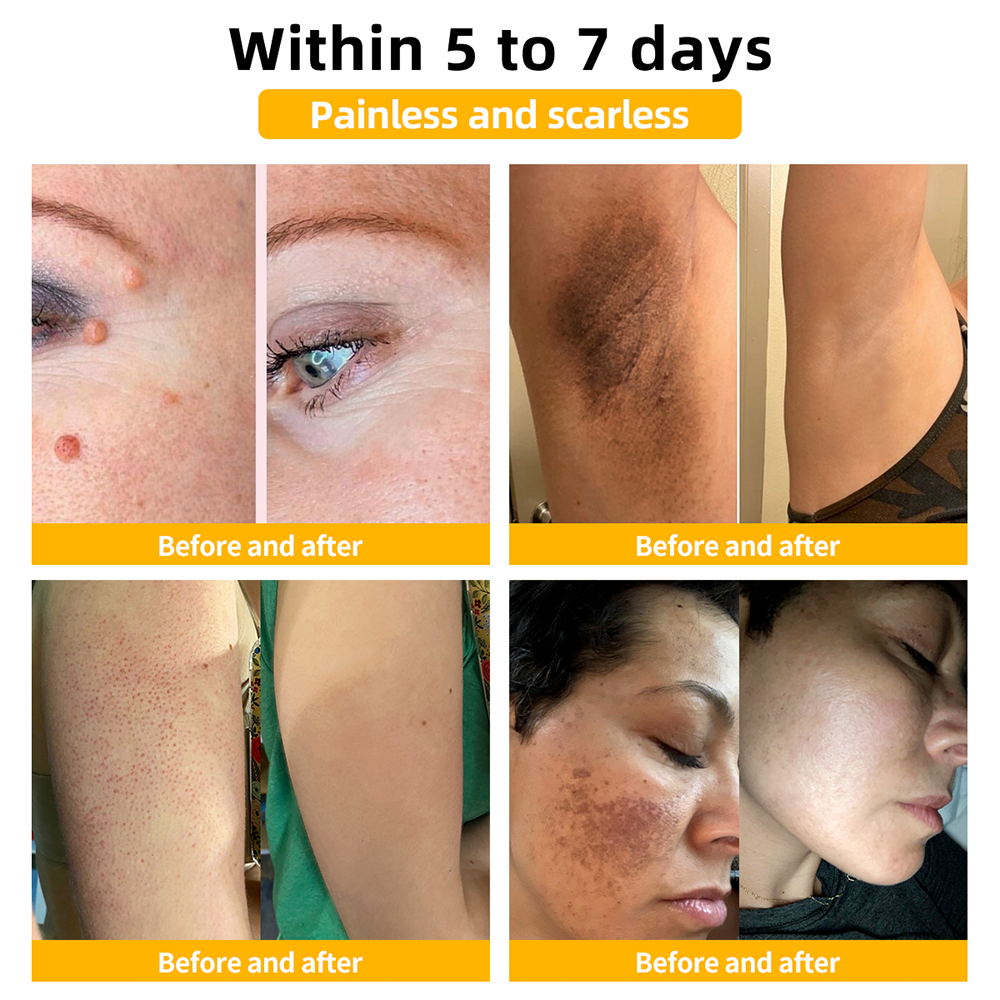 Turonu™ Bee Venom Treatment Cream 👩🏼‍⚕️（FDA Approved） (🔥𝑳𝒂𝒔𝒕 𝒅𝒂𝒚 𝒑𝒓𝒐𝒎𝒐𝒕𝒊𝒐𝒏 95% 𝒐𝒇𝒇)