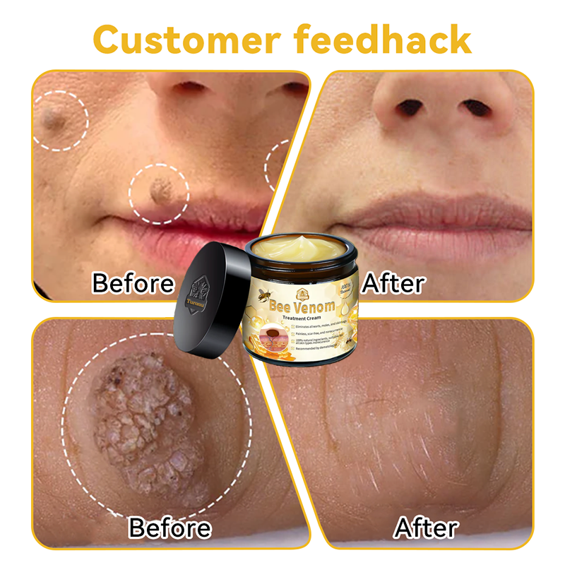 Turonu™ Bee Venom Treatment Cream 👩🏼‍⚕️（FDA Approved） (🔥𝑳𝒂𝒔𝒕 𝒅𝒂𝒚 𝒑𝒓𝒐𝒎𝒐𝒕𝒊𝒐𝒏 95% 𝒐𝒇𝒇)