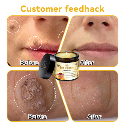 Turonu™ Bee Venom Treatment Cream 👩🏼‍⚕️（FDA Approved） (🔥𝑳𝒂𝒔𝒕 𝒅𝒂𝒚 𝒑𝒓𝒐𝒎𝒐𝒕𝒊𝒐𝒏 95% 𝒐𝒇𝒇)