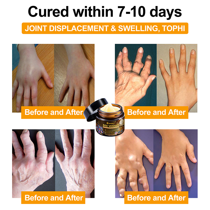 Official Store:  🦵Jorondy™ Bee Venom Arthritis Therapy Cream(Specially for older adults & AAOS recommends)🔥𝑳𝒂𝒔𝒕 𝒅𝒂𝒚 𝒑𝒓𝒐𝒎𝒐𝒕𝒊𝒐𝒏 8𝟎% 𝒐𝒇𝒇