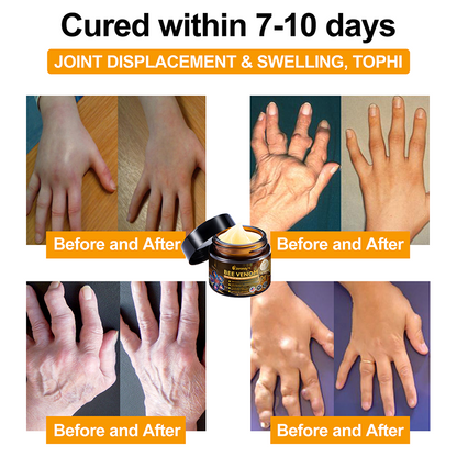 Official Store:  🦵Jorondy™ Bee Venom Arthritis Therapy Cream(Specially for older adults & AAOS recommends)🔥𝑳𝒂𝒔𝒕 𝒅𝒂𝒚 𝒑𝒓𝒐𝒎𝒐𝒕𝒊𝒐𝒏 8𝟎% 𝒐𝒇𝒇