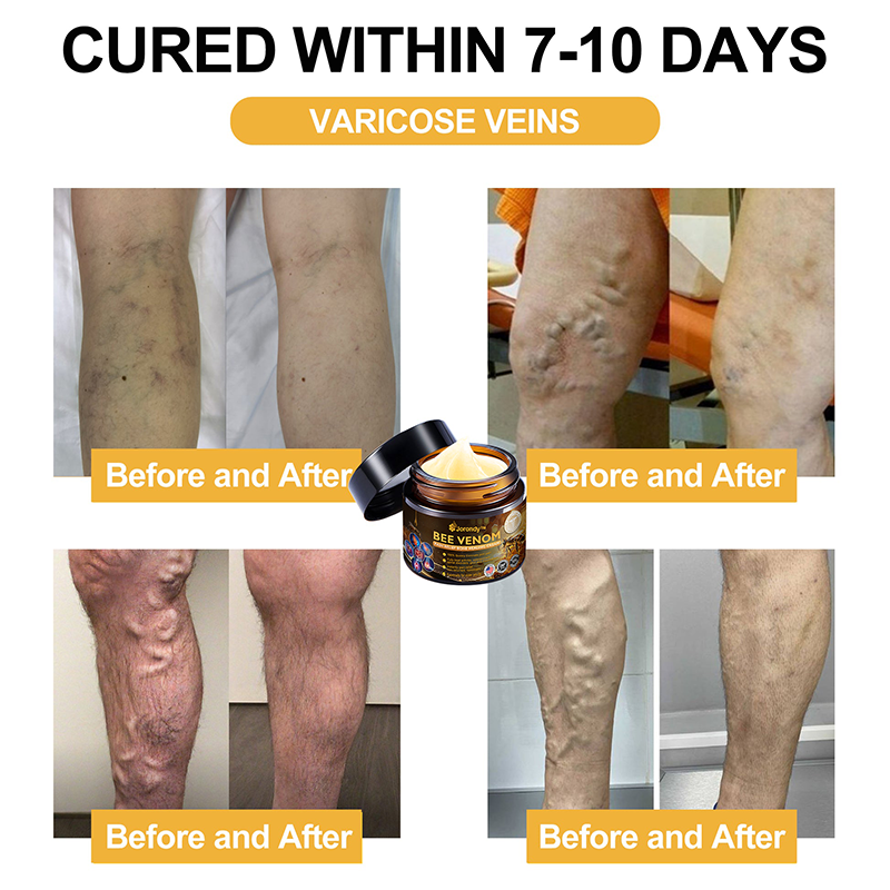 Official Store:  🦵Jorondy™ Bee Venom Arthritis Therapy Cream(Specially for older adults & AAOS recommends)🔥𝑳𝒂𝒔𝒕 𝒅𝒂𝒚 𝒑𝒓𝒐𝒎𝒐𝒕𝒊𝒐𝒏 8𝟎% 𝒐𝒇𝒇