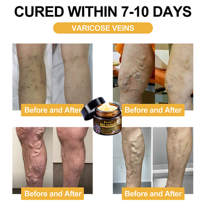 Official Store:  🦵Jorondy™ Bee Venom Arthritis Therapy Cream(Specially for older adults & AAOS recommends)🔥𝑳𝒂𝒔𝒕 𝒅𝒂𝒚 𝒑𝒓𝒐𝒎𝒐𝒕𝒊𝒐𝒏 8𝟎% 𝒐𝒇𝒇