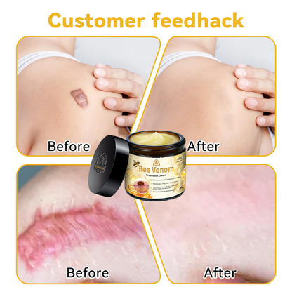 Turonu™ Bee Venom Treatment Cream 👩🏼‍⚕️（FDA Approved） (🔥𝑳𝒂𝒔𝒕 𝒅𝒂𝒚 𝒑𝒓𝒐𝒎𝒐𝒕𝒊𝒐𝒏 95% 𝒐𝒇𝒇)