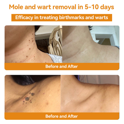 Turonu™ Bee Venom Treatment Cream 👩🏼‍⚕️（FDA Approved） (🔥𝑳𝒂𝒔𝒕 𝒅𝒂𝒚 𝒑𝒓𝒐𝒎𝒐𝒕𝒊𝒐𝒏 95% 𝒐𝒇𝒇)